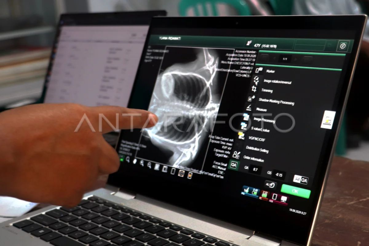 Tangan menunjuk hasil rontgen dada di layar laptop saat pemeriksaan kesehatan